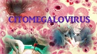 Citomegalovirus [upl. by Nevur]