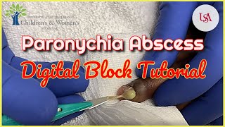 Finger Paronychia Emergency amp Digital Block Tutorial [upl. by Donella]