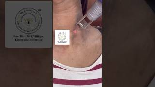 Lichen Planus Pigmentosus treatment with Q switched Laser dermatologist skinclinic chembur skin [upl. by Missak]