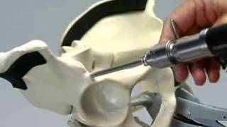 external fixation of anterior pelvic ring [upl. by Vernen254]