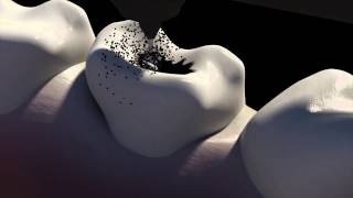 3d Animation of Caries Removal amp The Cavity Filling Procedure  NYC Dentist  Dr Simon Rosenberg [upl. by Enelie807]