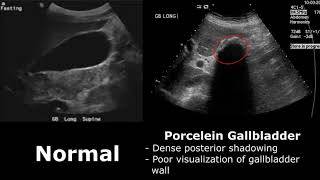 Gallbladder Ultrasound Normal Vs Abnormal Image Appearances Comparison  Gallbladder Pathologies [upl. by Hsirk]