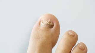 How to prevent and treat nail fungus [upl. by Gabriella]