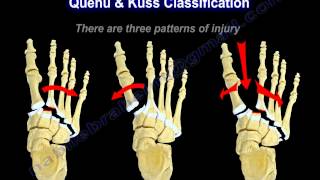 Lisfranc Injuries  Everything You Need To Know  Dr Nabil Ebraheim [upl. by Howzell]