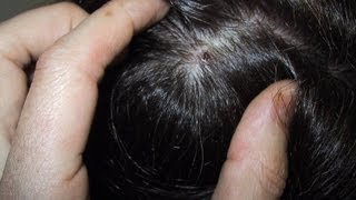 How to Treat a Dry Scalp DermTVcom Epi 482 [upl. by Diraf]