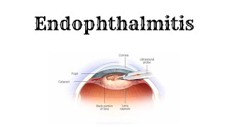 ENDOPHTHALMITIS Explained in 2 minutes [upl. by Huber]