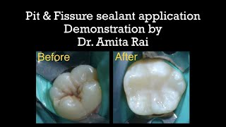 Pit amp Fissure sealant application Demonstration by Dr Amita Rai [upl. by Warenne]