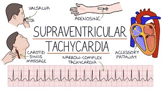 Understanding Supraventricular Tachycardia SVT [upl. by Danila]