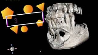 Mandibular Cyst [upl. by Willard]