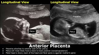 Placenta Positions On Ultrasound  AnteriorPosteriorFundalLateral Placental Positioning USG [upl. by Os]