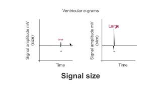 Pacemaker sensing and fixed sensitivity [upl. by Enoyrt]