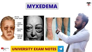 Myxedema  Hypothyroidism  Endocrine Physiology [upl. by Ahsenor226]