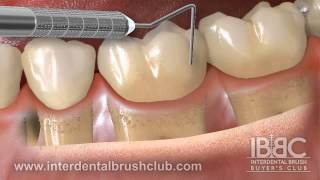 WHY IS INTERDENTAL BRUSHING SO IMPORTANT AFTER POCKET REDUCTION GUM SUGERYmp4 [upl. by Yamauchi627]