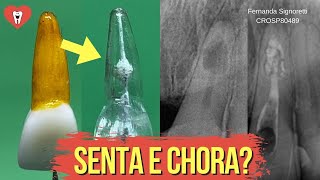 ENDODONTIA EM REABSORÇÃO INTERNA  PASSO A PASSO  Endolovers [upl. by Hallock]