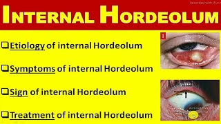 internal hordeolum [upl. by Westfahl]