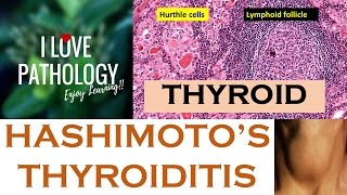 HASHIMOTOS THYROIDITIS Etiopathogenesis Morphology amp Complications [upl. by Avirt]