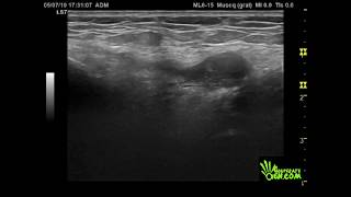 Bursitis PES Anserina [upl. by Nevur]