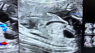 View of Ductus venosus  fetus in supine breech position [upl. by Tiossem250]