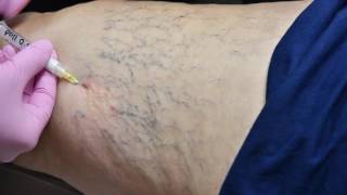 Allure Vein Center Sclerotherapy Spider Vein Treatment [upl. by Spielman]