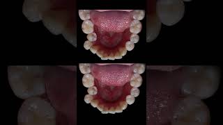 Braces process  Tooth Arc fix [upl. by Iraj637]