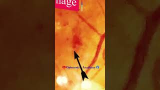 Retinal hemorrhage  Diabetic retinopathy  Fundus Photography  Short Video 106 optometry [upl. by Nylsaj]