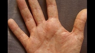 Dermatitis or Dyshidrosis How I Prevent Getting Painful And Unsightly Summer Hands [upl. by Etnovaj]