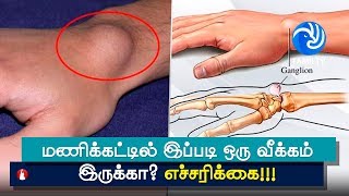 Ganglion Cyst Symptoms Causes and Treatment  Tamil TV [upl. by Noyes]