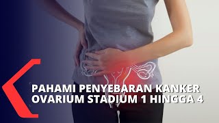 Begini Kondisi Penyebaran Kanker Ovarium Stadium 1 Hingga 4 [upl. by Yllen343]