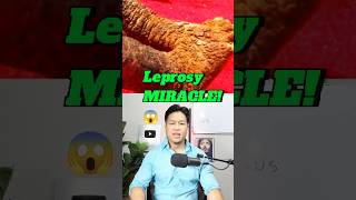 Leprosy Healing MIRACLE 😱 prayer supernatural [upl. by Chud]