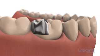 Inlays and onlays  Lapointe dental centres [upl. by Iaka257]