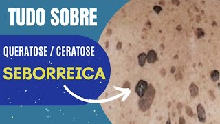 Tudo sobre queratose  ceratose seborreica [upl. by Dnalra]