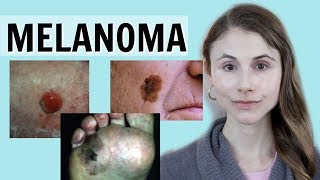 Melanoma skin cancer QampA with dermatologist Dr Dray [upl. by Emmit]