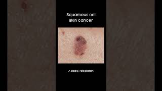 What do basal cell and squamous cell skin cancers look like [upl. by Siugram]