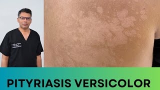 Tinea Versicolor How to Treat [upl. by Ahdar]