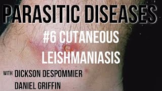 Parasitic Diseases Lectures 6 Cutaneous Leishmaniasis [upl. by Schulze204]