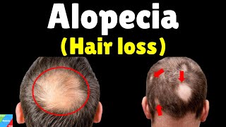 Alopecia Hair loss – Symptoms Causes Diagnosis Treatment Complications Preventions [upl. by Ludwog]