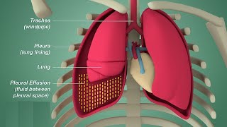 Pleural effusion  Internal medicine Etiology Clinical Features Diagnosis and Treatment Usmle [upl. by Nema]