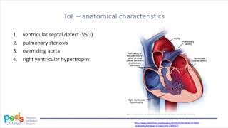 Tetralogy of Fallot [upl. by Deadman914]