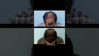 5 Months Hair Transplant Results  Dadu Medical Centre hairlosscure [upl. by Sairu]