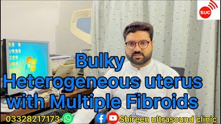 Bulky heterogeneous with multiple fibroids [upl. by Llekcor]