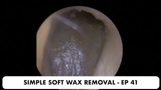 SIMPLE SOFT EAR WAX REMOVAL  EP 41 [upl. by Fidelis]