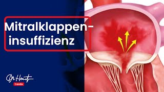 Mitralklappeninsuffizienz  einfach erklärt  DrHeart [upl. by Cooper]