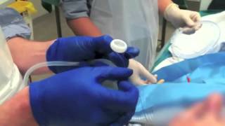 Peg Tube Insertion Video [upl. by Scot]