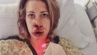 Woman Has No Memory of How She Sustained Horrible Injuries During Bike Ride [upl. by Nuhsar573]