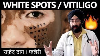 How to Cure सफ़ेद दाग White Spots Vitiligo Leucoderma Hypopigmentation HINDI DrEducation [upl. by Horwath]