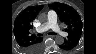 Patent ductus arteriosus may mimics Pulmonary Embolism  CTPA [upl. by Alten493]