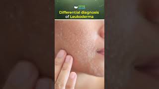 Differential diagnosis of Leukoderma [upl. by Anitsuga105]