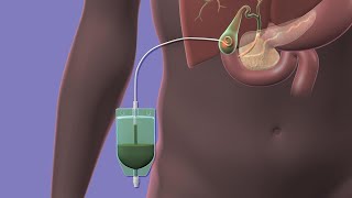 Your Percutaneous Cholecystostomy Drain [upl. by Nayk]