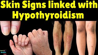 Skin Signs linked with Hypothyroidism Underactive Thyroid [upl. by Narra]