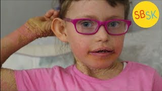 Living With Scaly Skin Ichthyosis [upl. by Croner]